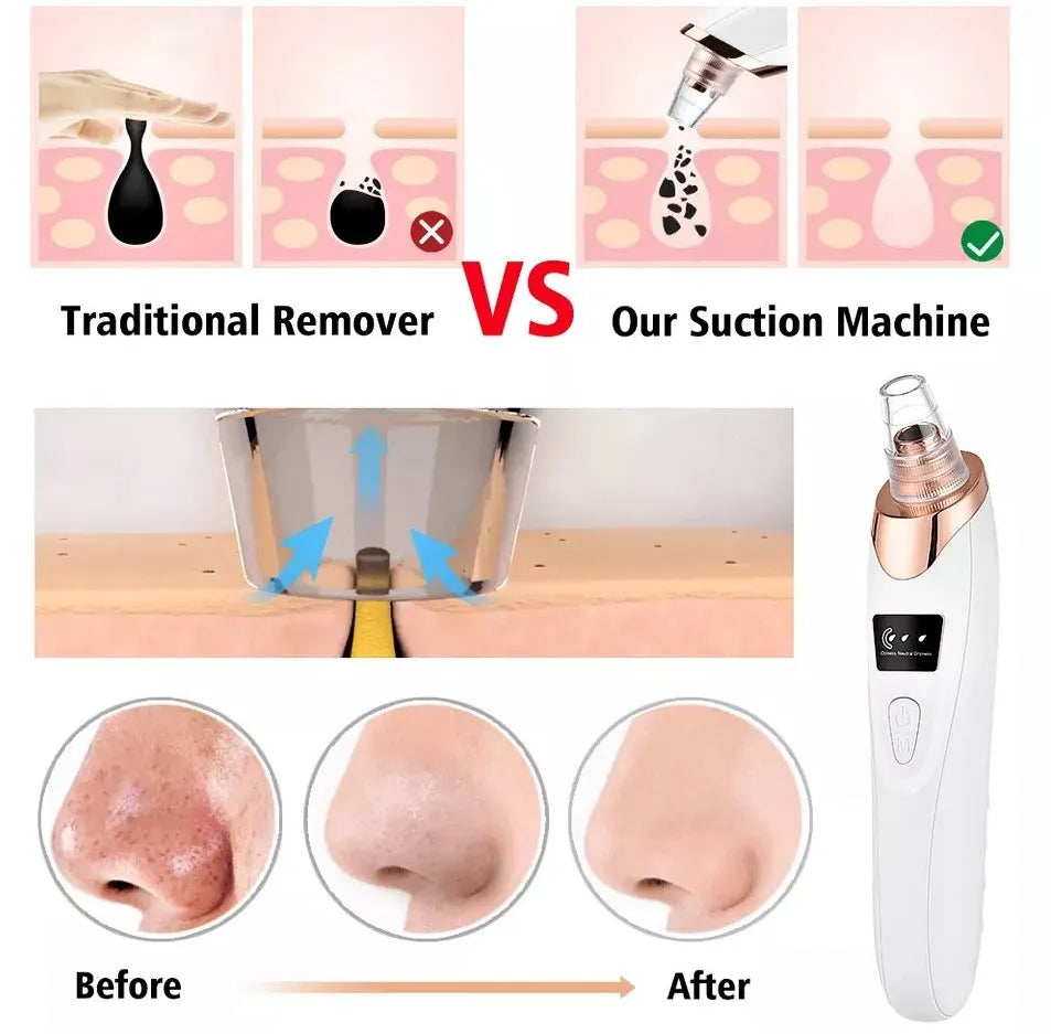 5-in-1 Blackhead Remover Machine – Rechargeable Pore Vacuum Facial Cleaner